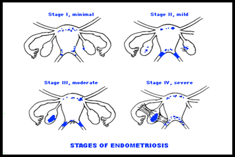 esatdios endometriosis 2